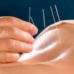 Elk Grove Acupuncture