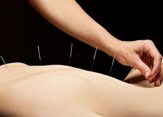 Acupuncture Miami