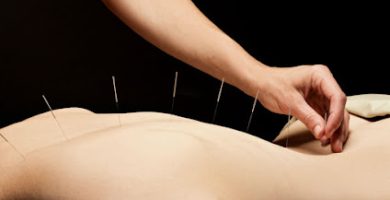 Acupuncture Miami