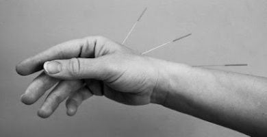 Auburn Acupuncture