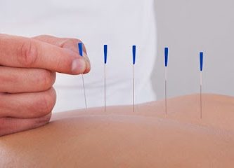 Oriental Acupuncture