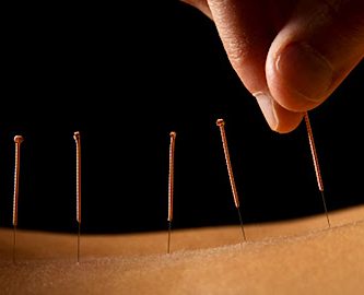 Acupuncture Alternatives