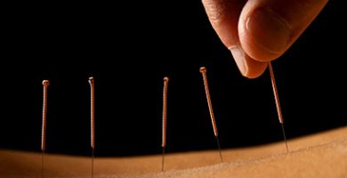 Acupuncture Alternatives