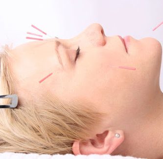 American Acupuncture